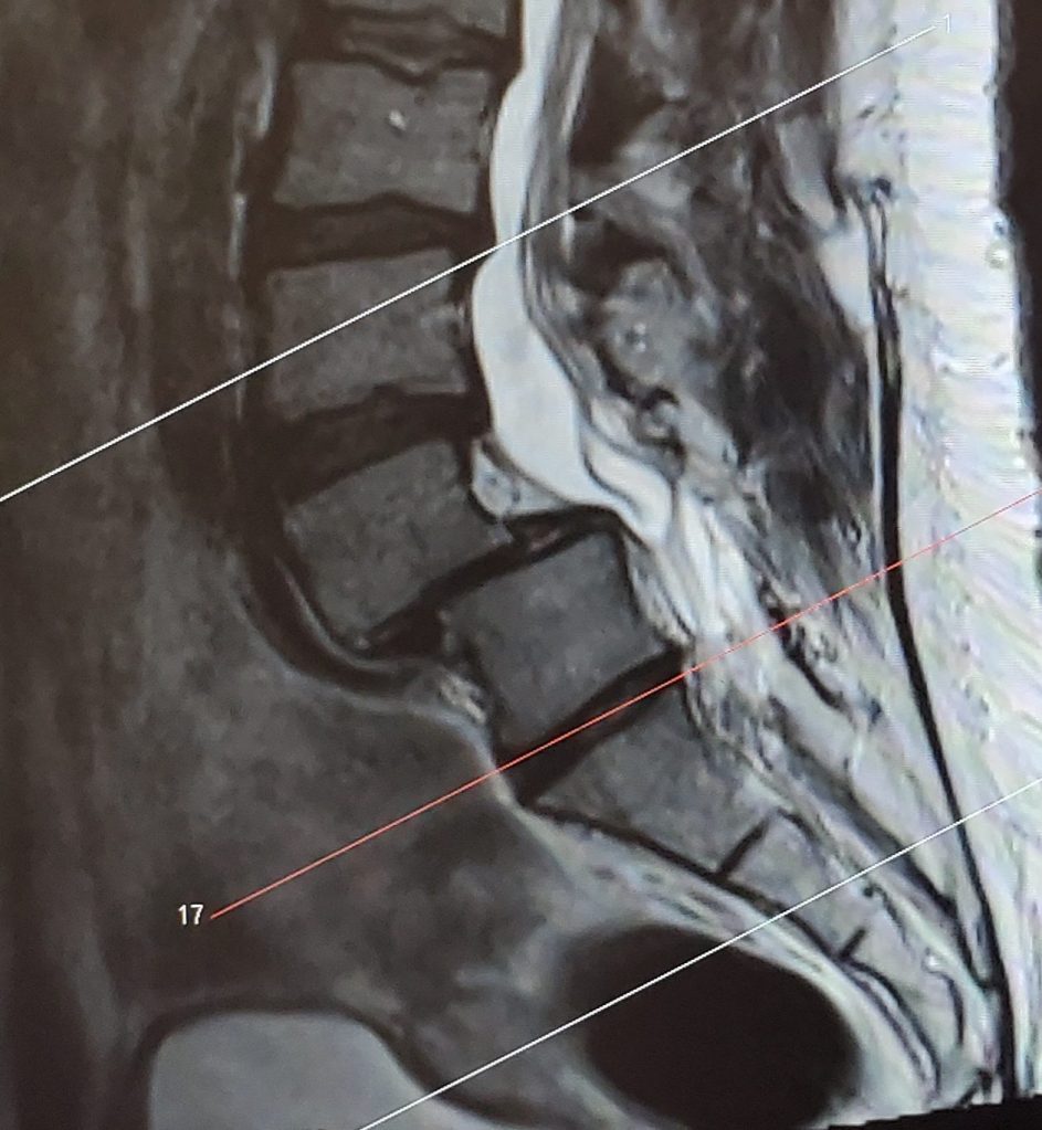 Grade III spondylolisthesis at L4-L5
